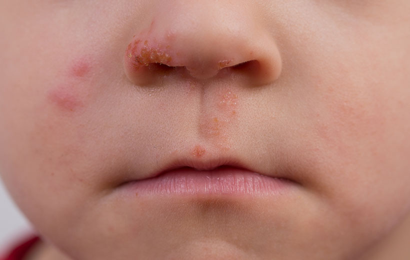 Фурункул носа: причины, стадии, лечение