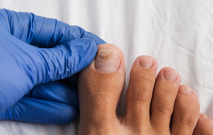 Онихомикоз: причины и лечение грибка ногтей